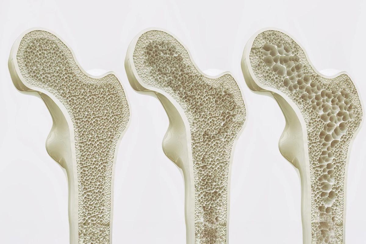 Nutrients Required for Strong Bones including calcium rich foods, vitamins and minerals for bone health